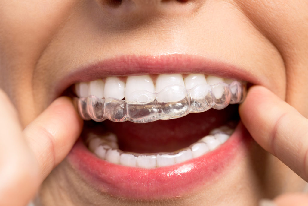 6 Benefits Of Invisalign Life Smile Dental Care